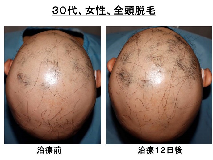 円形脱毛症　病院